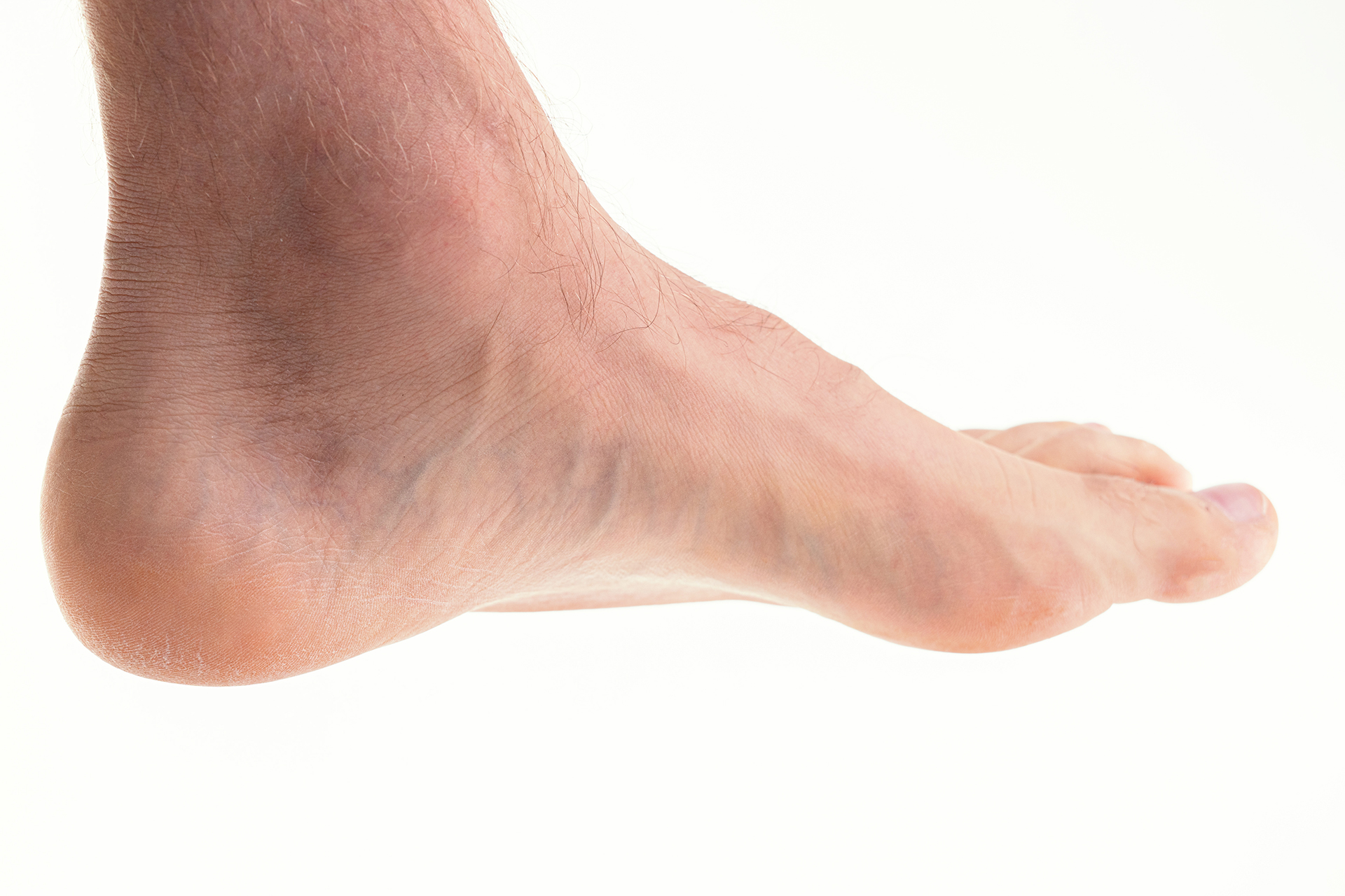 high arch foot