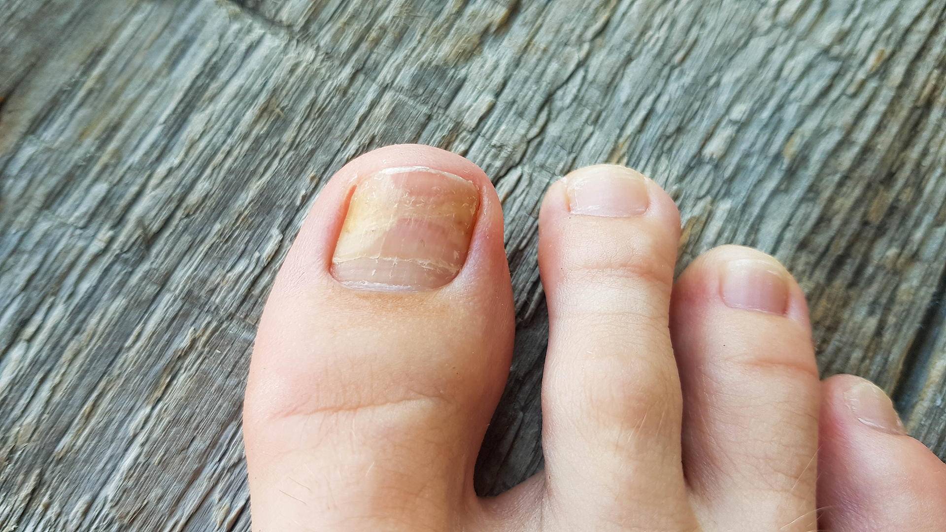 how to get rid of fungal infection in toenails