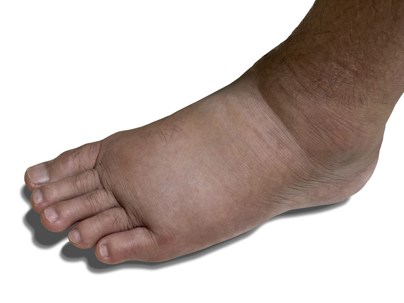 how to get rid of gout in ankle