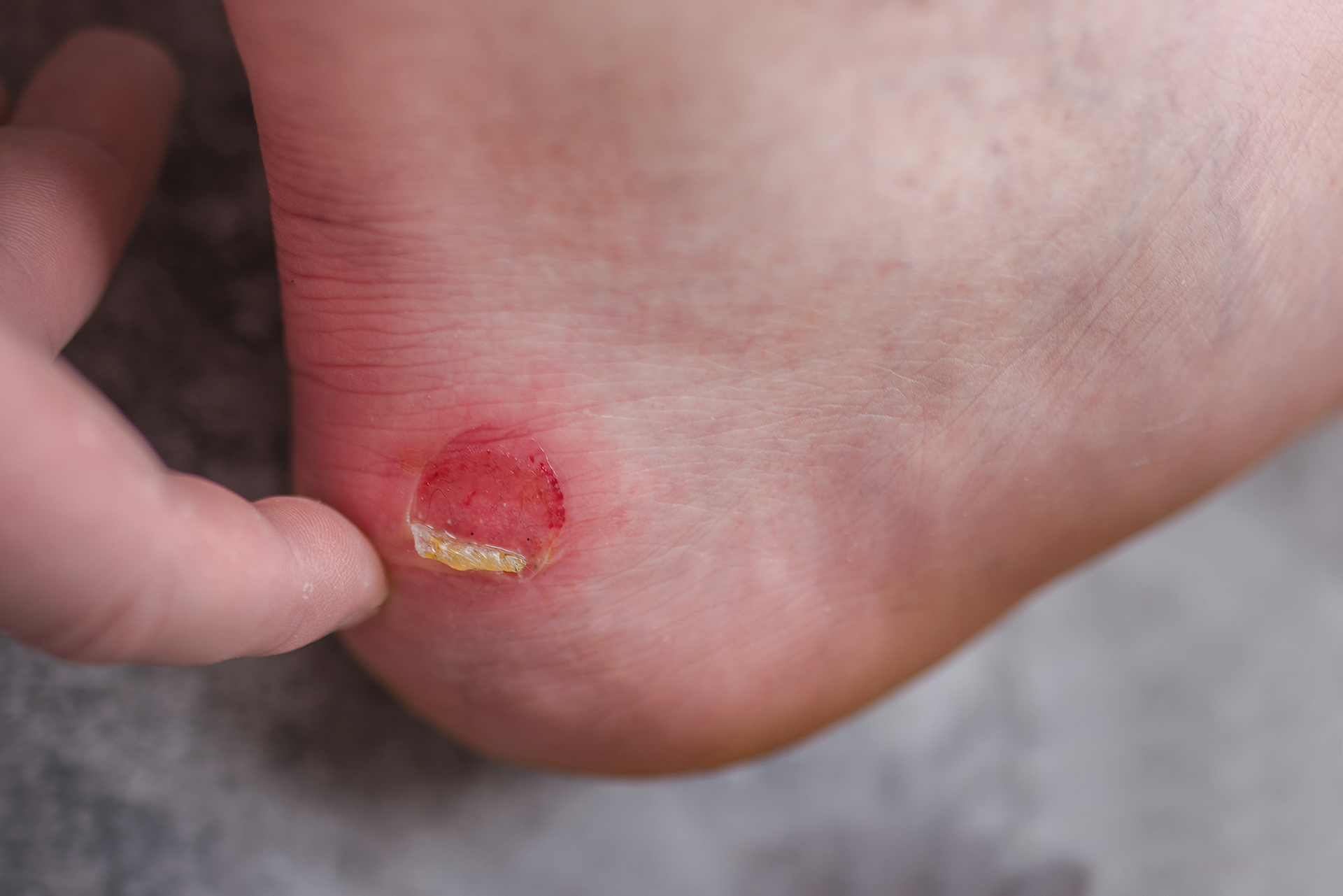 how to treat blisters on feet from running