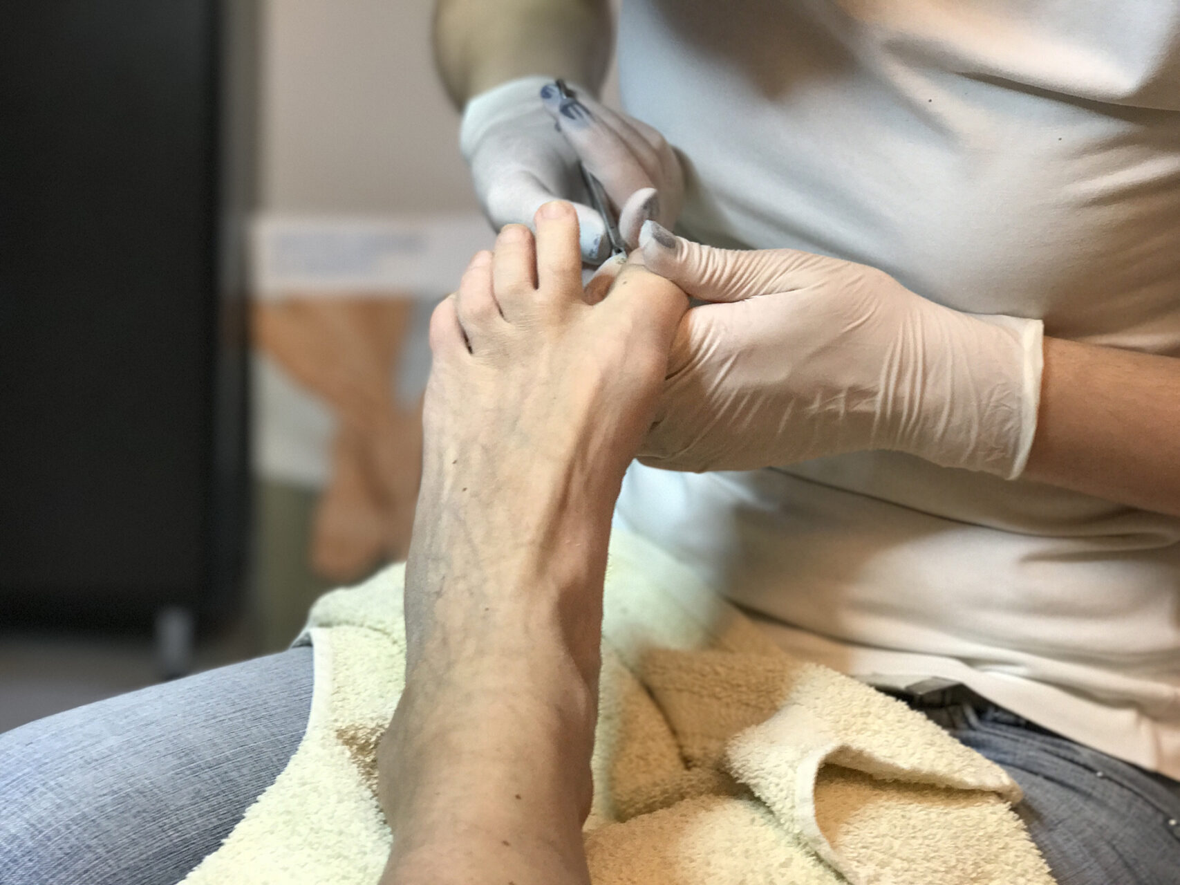 ingrown toenail extraction