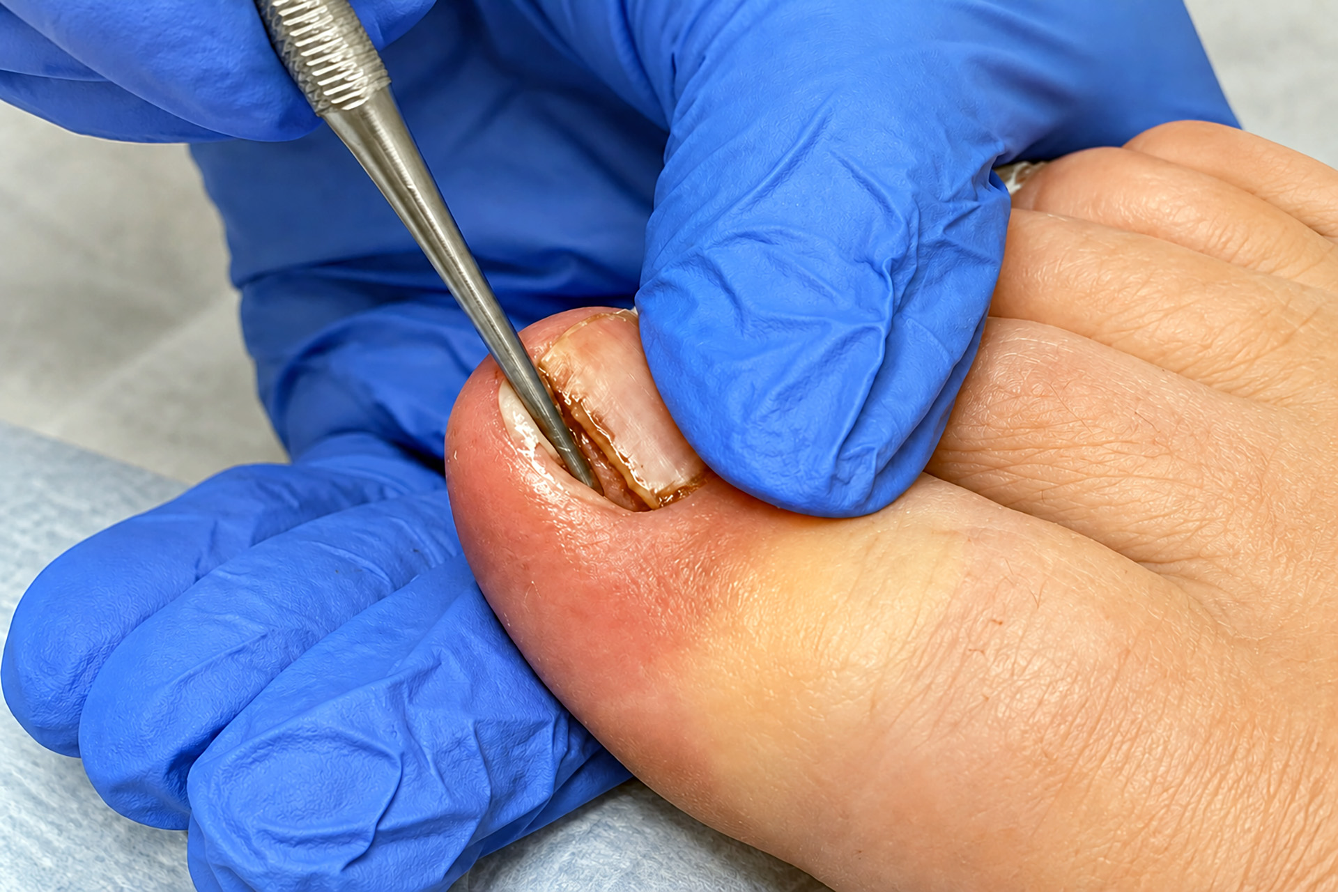 ingrown toenail removal Singapore