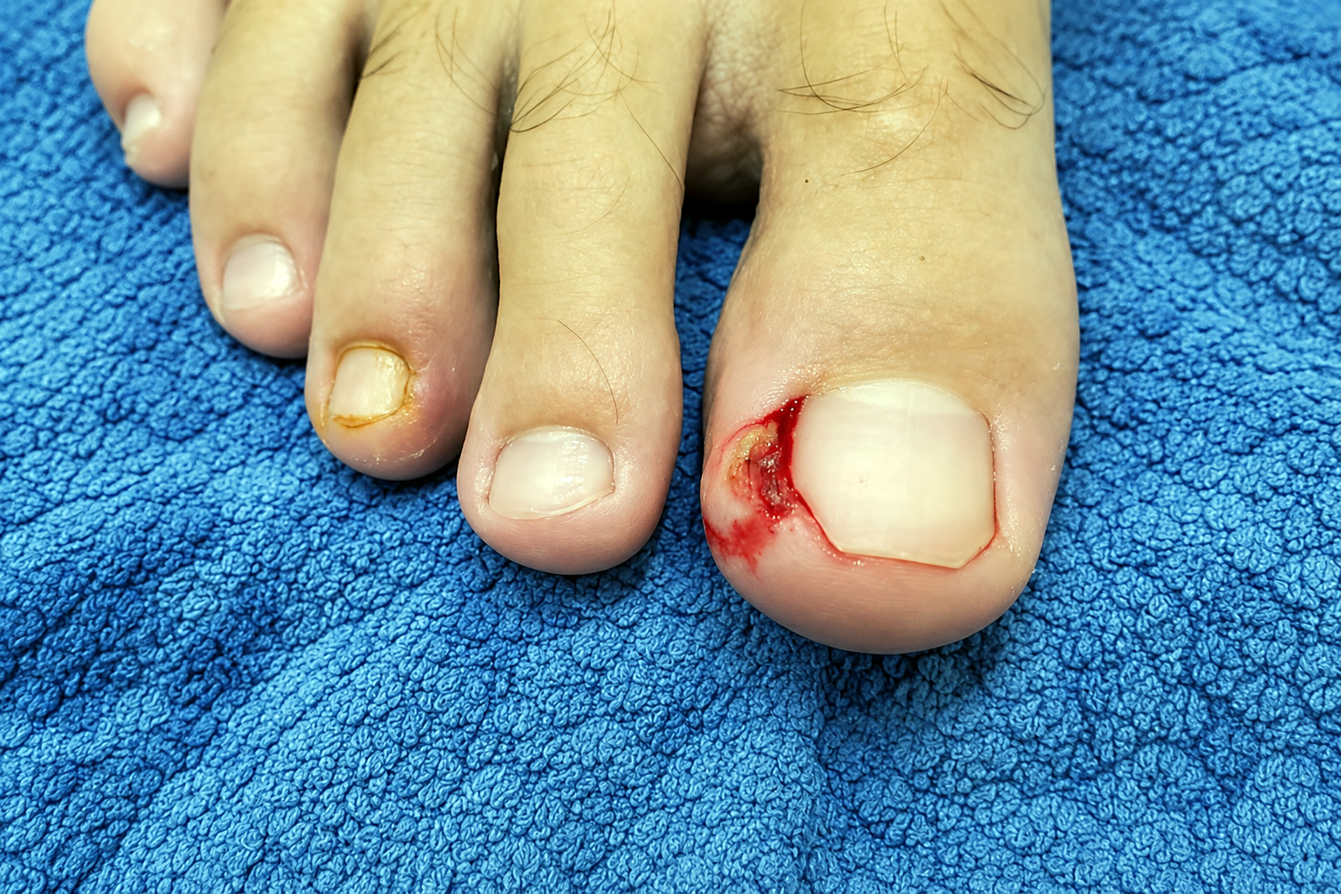 ingrown toenail removal procedure