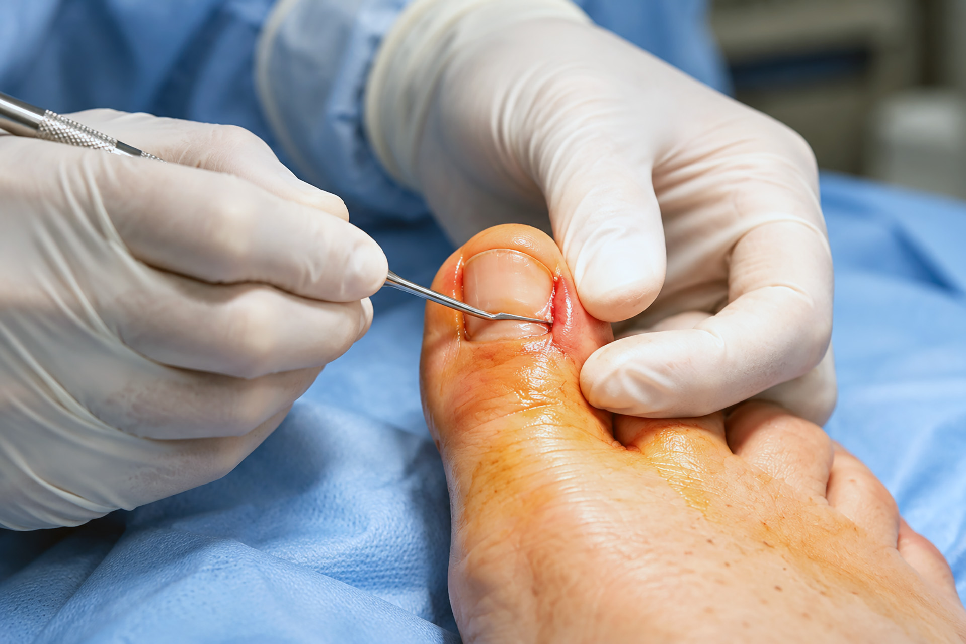 ingrown toenail removal surgery