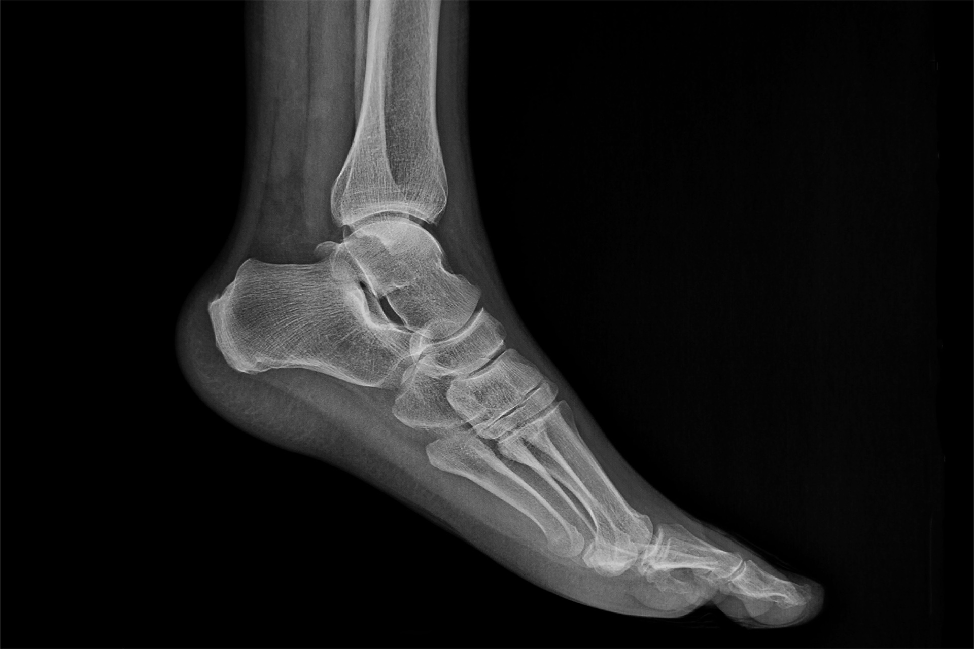 insertional Achilles tendonitis X-ray