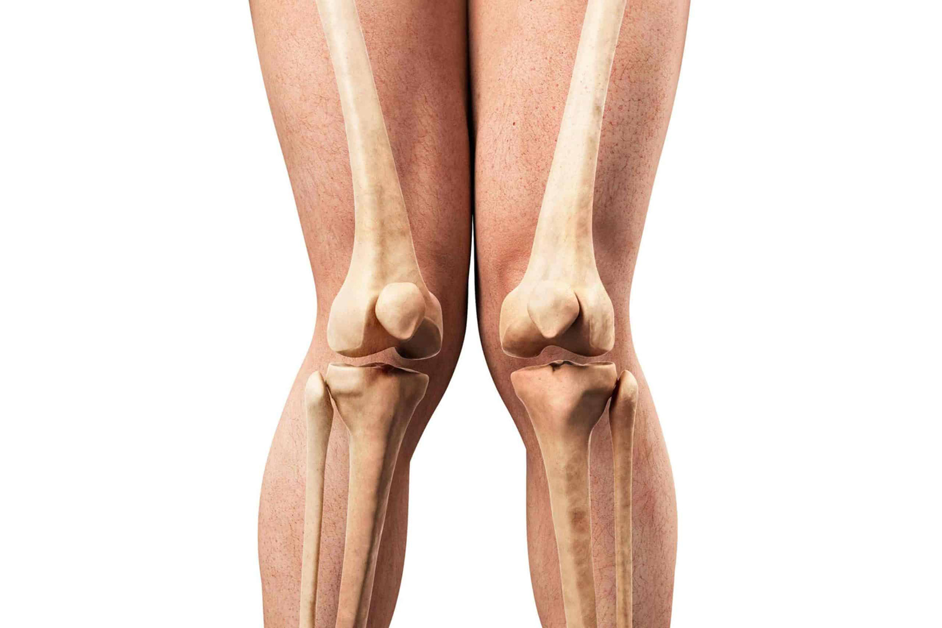 knock knees picture