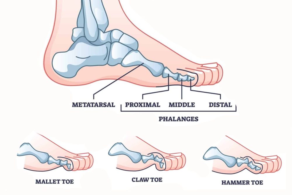 Hammertoe Correction without Surgery - The Foot Practice Podiatry Clinic