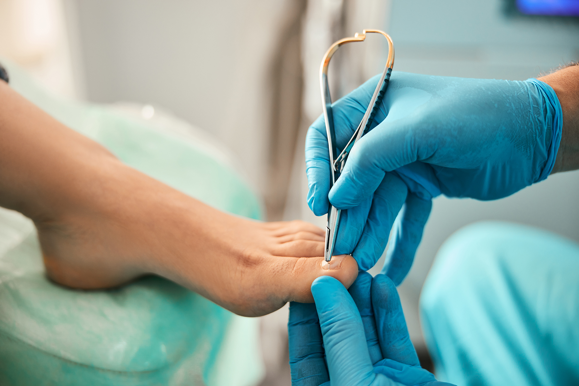 nail wedge resection