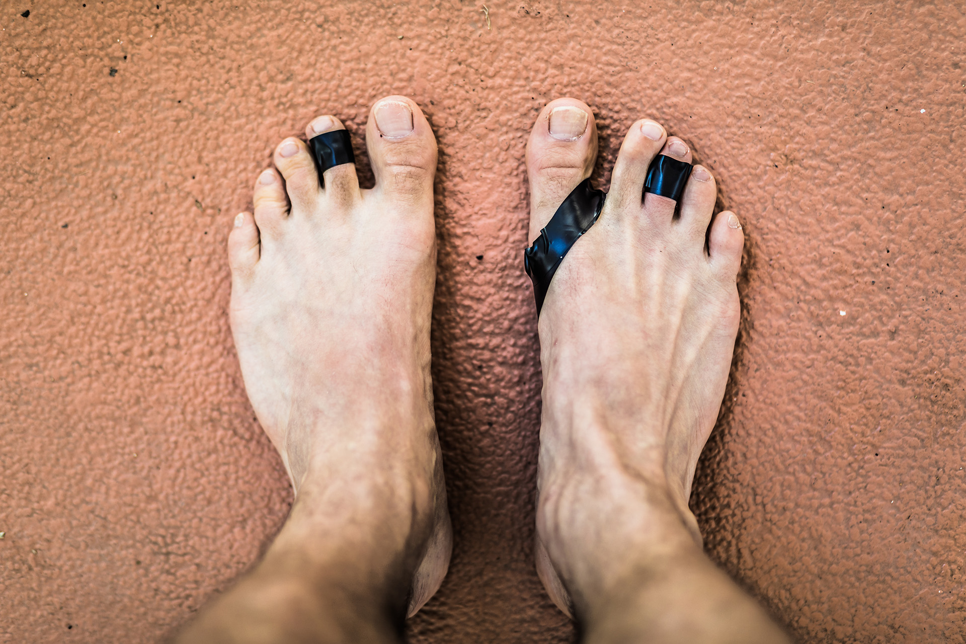 plantar plate injury