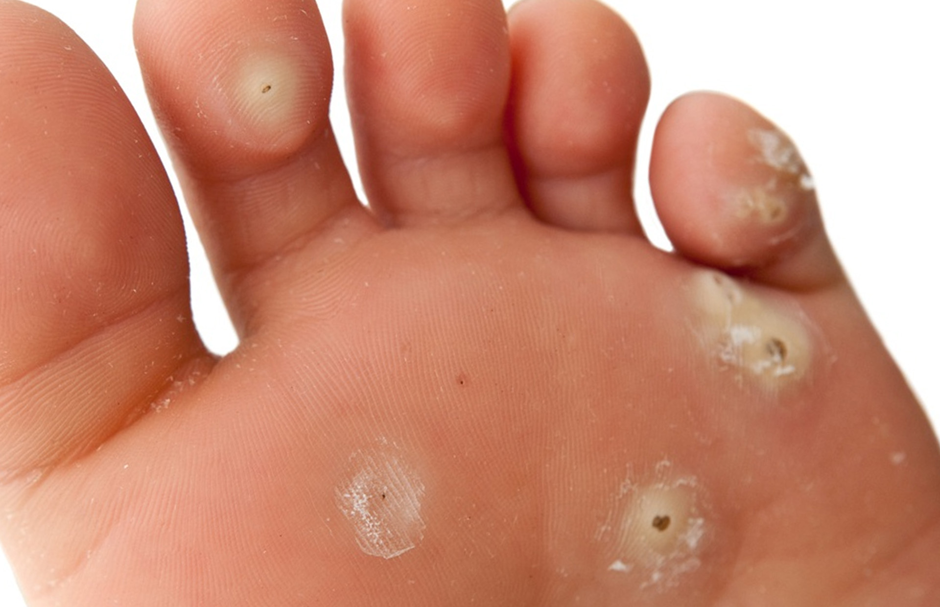 plantar wart on foot