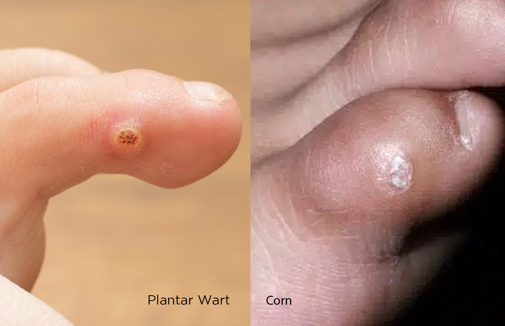 plantar wart vs corn