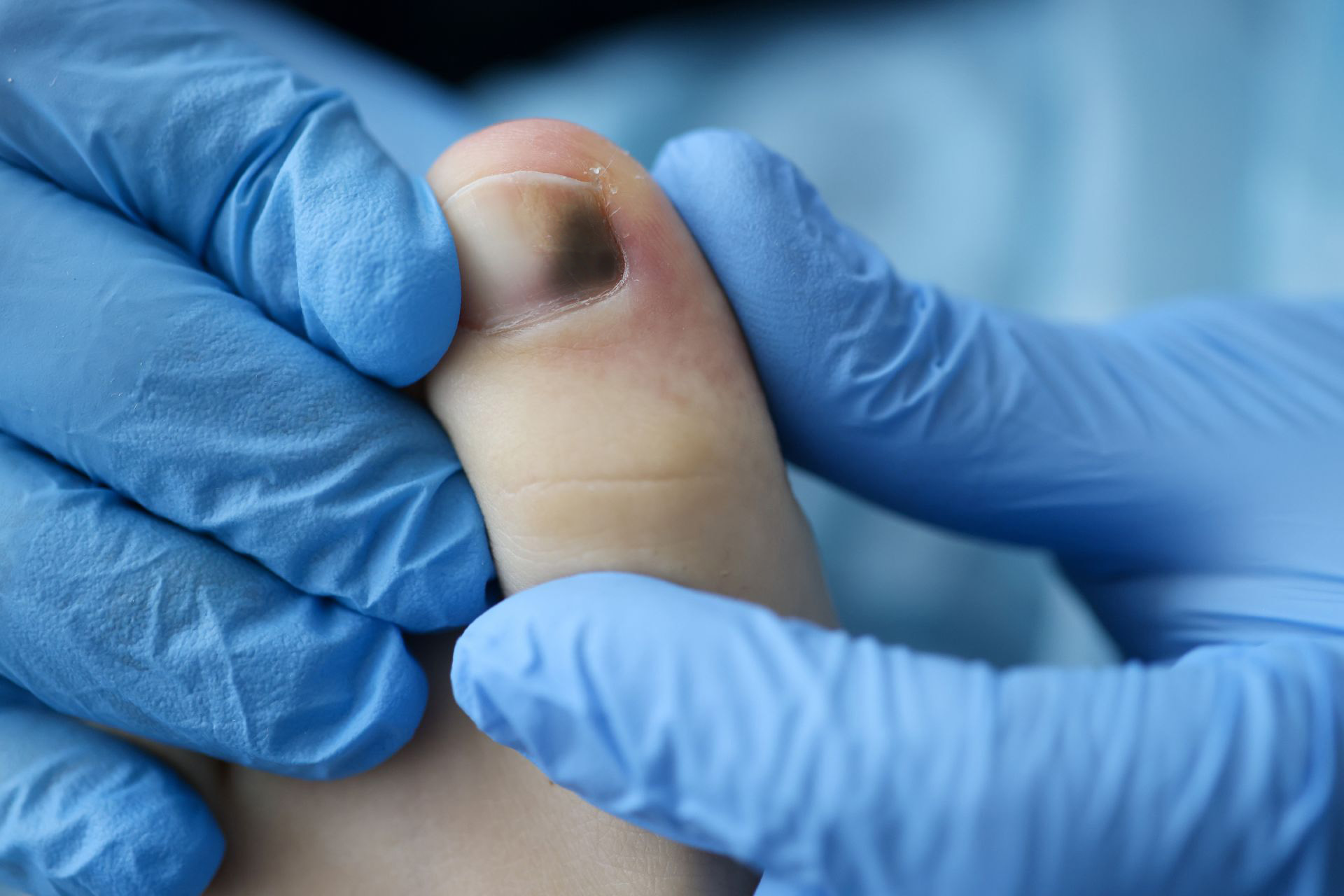 Podiatrist remedy for black nail fungus in Singapore