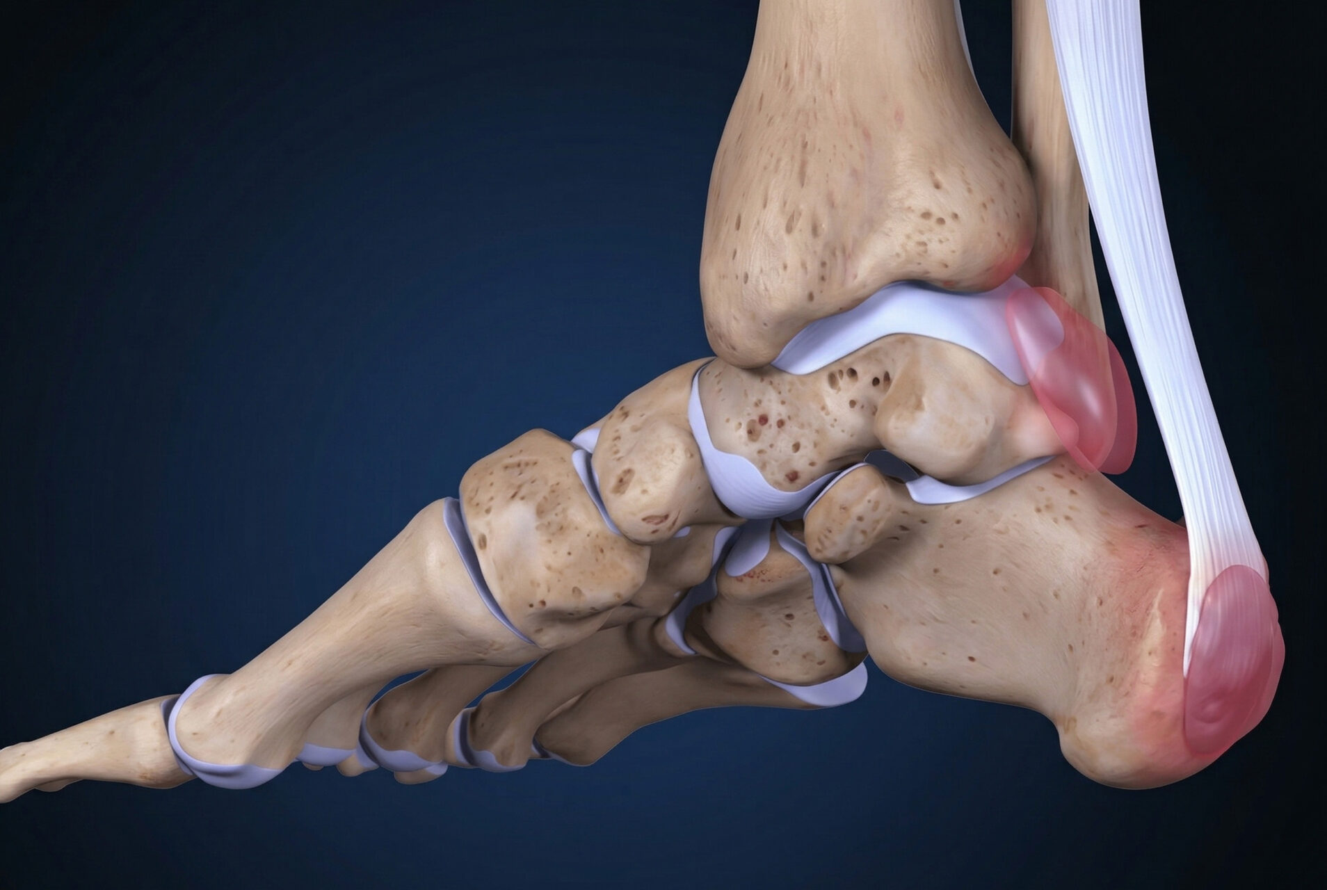 retrocalcaneal bursitis symptoms