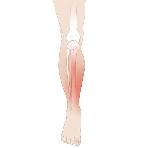 shin splints illustration