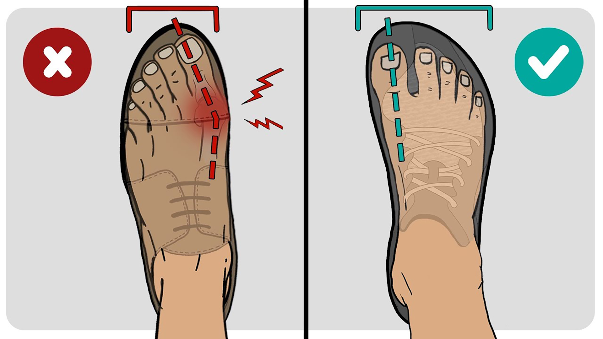 shoes for bunions Singapore