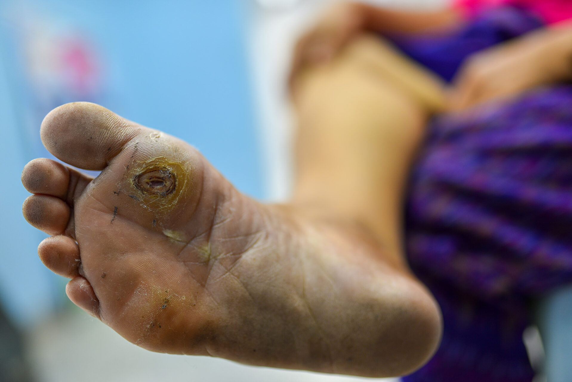 signs and symptoms of diabetic foot ulcer