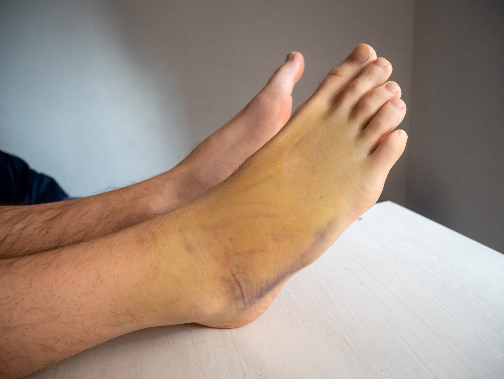 signs of gout in ankle