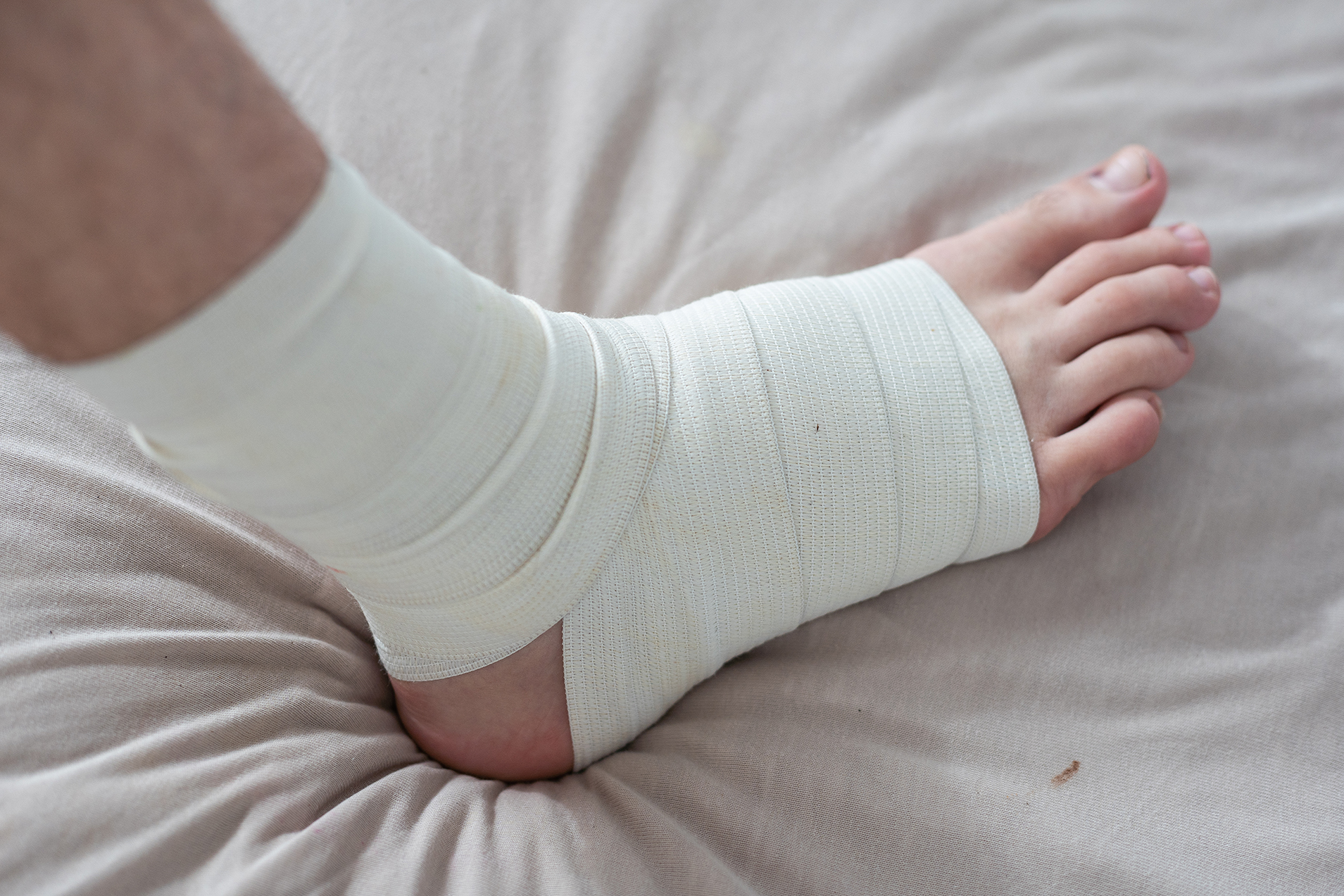 talar dome fracture treatment