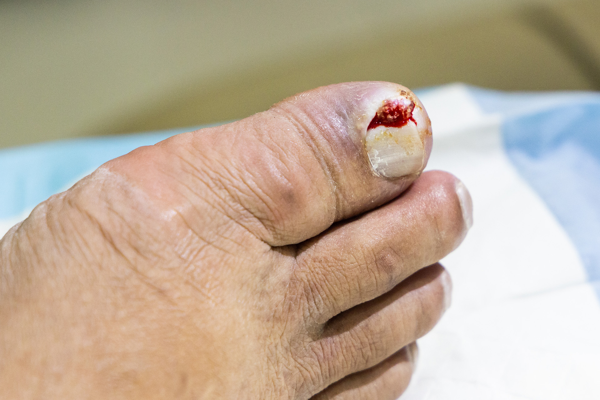 toe infected ingrown toenail