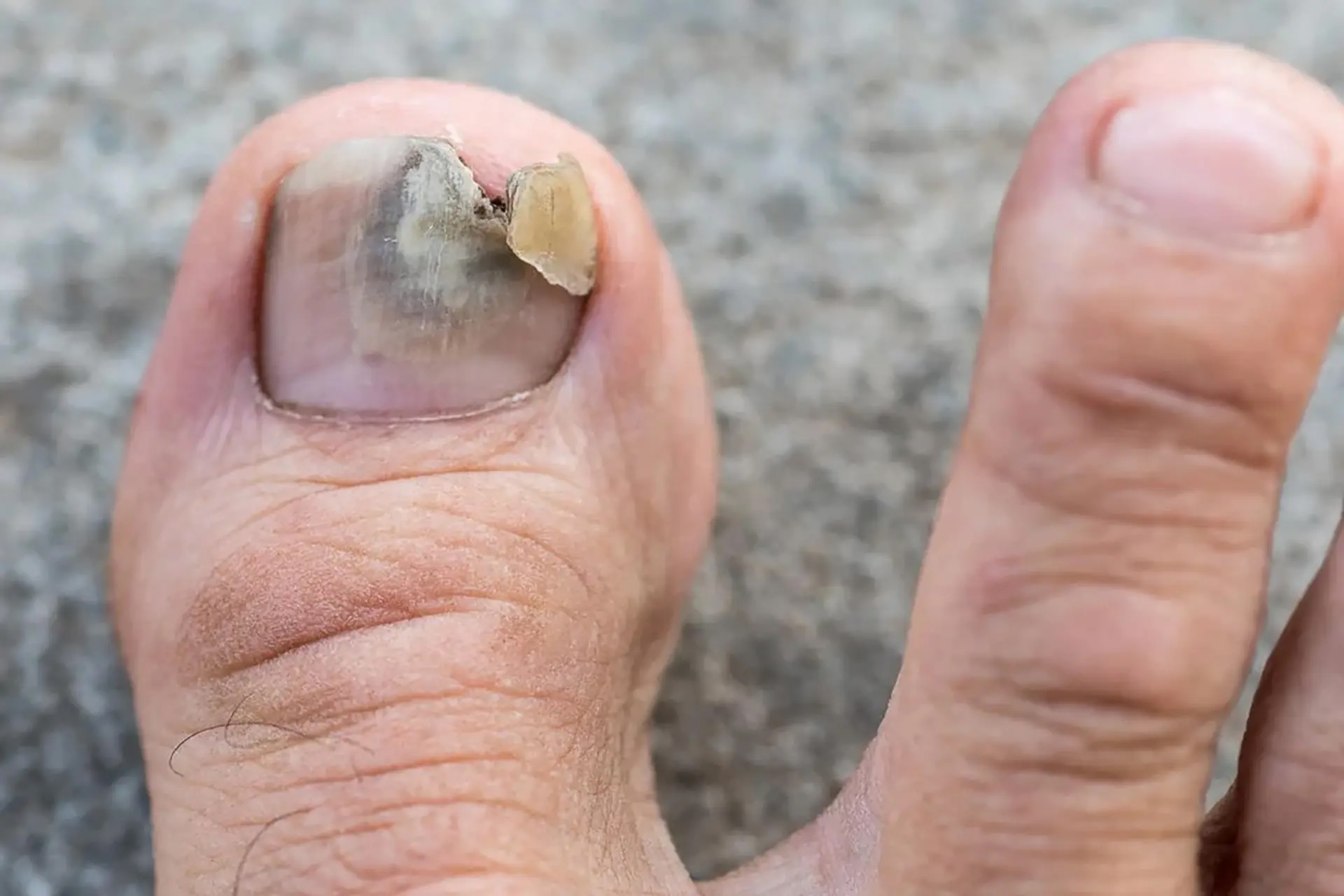 toenail fungal infection Singapore