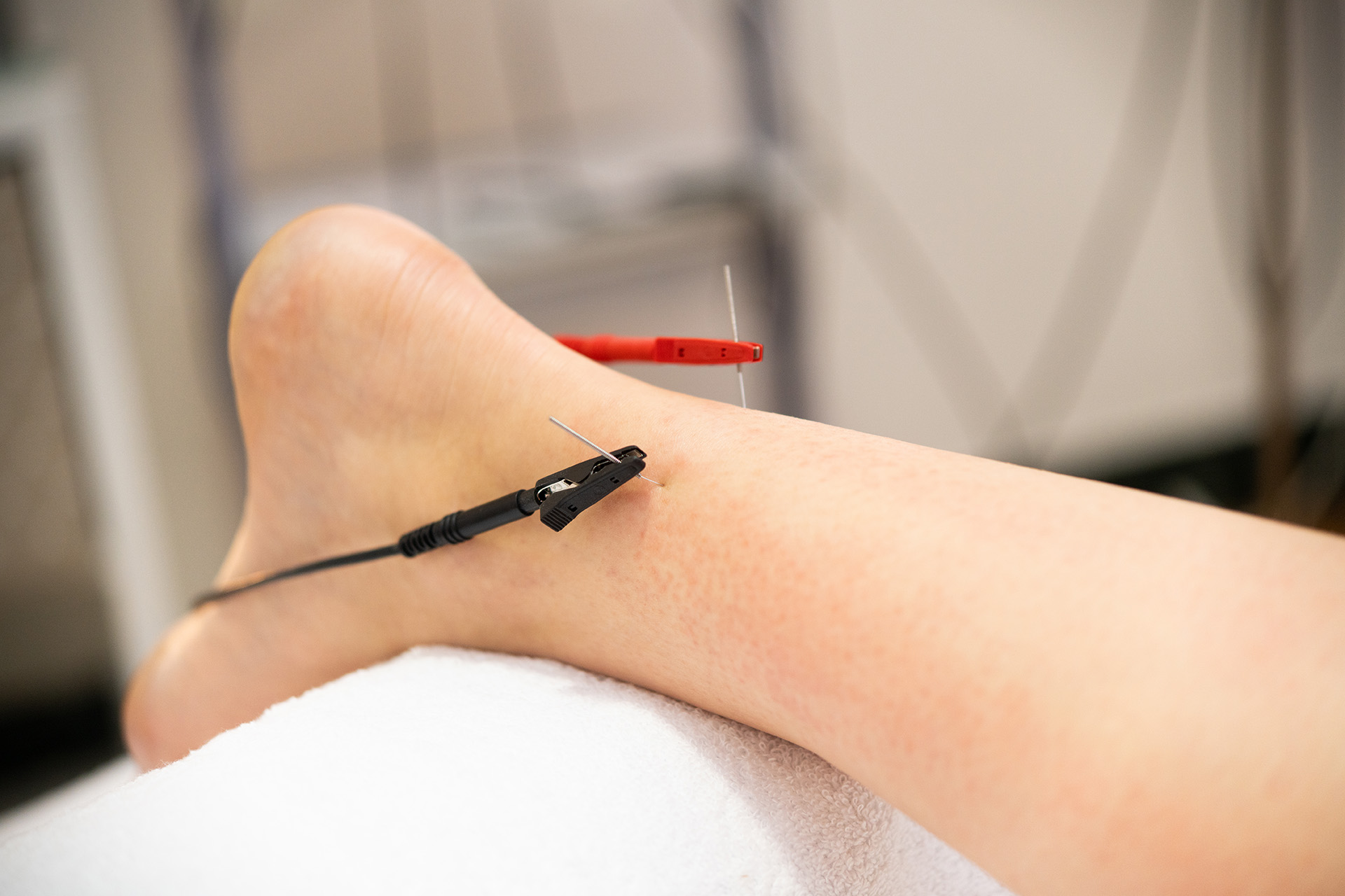 treatment Mortons neuroma