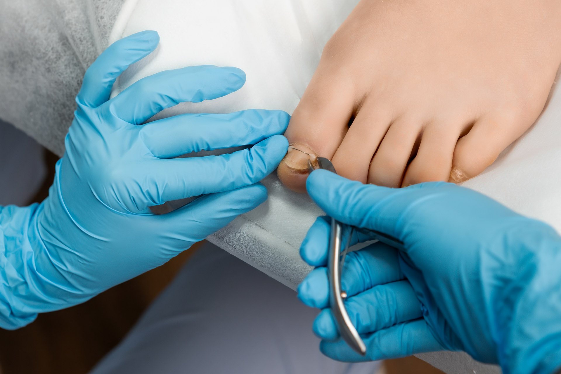 wedge resection toenail