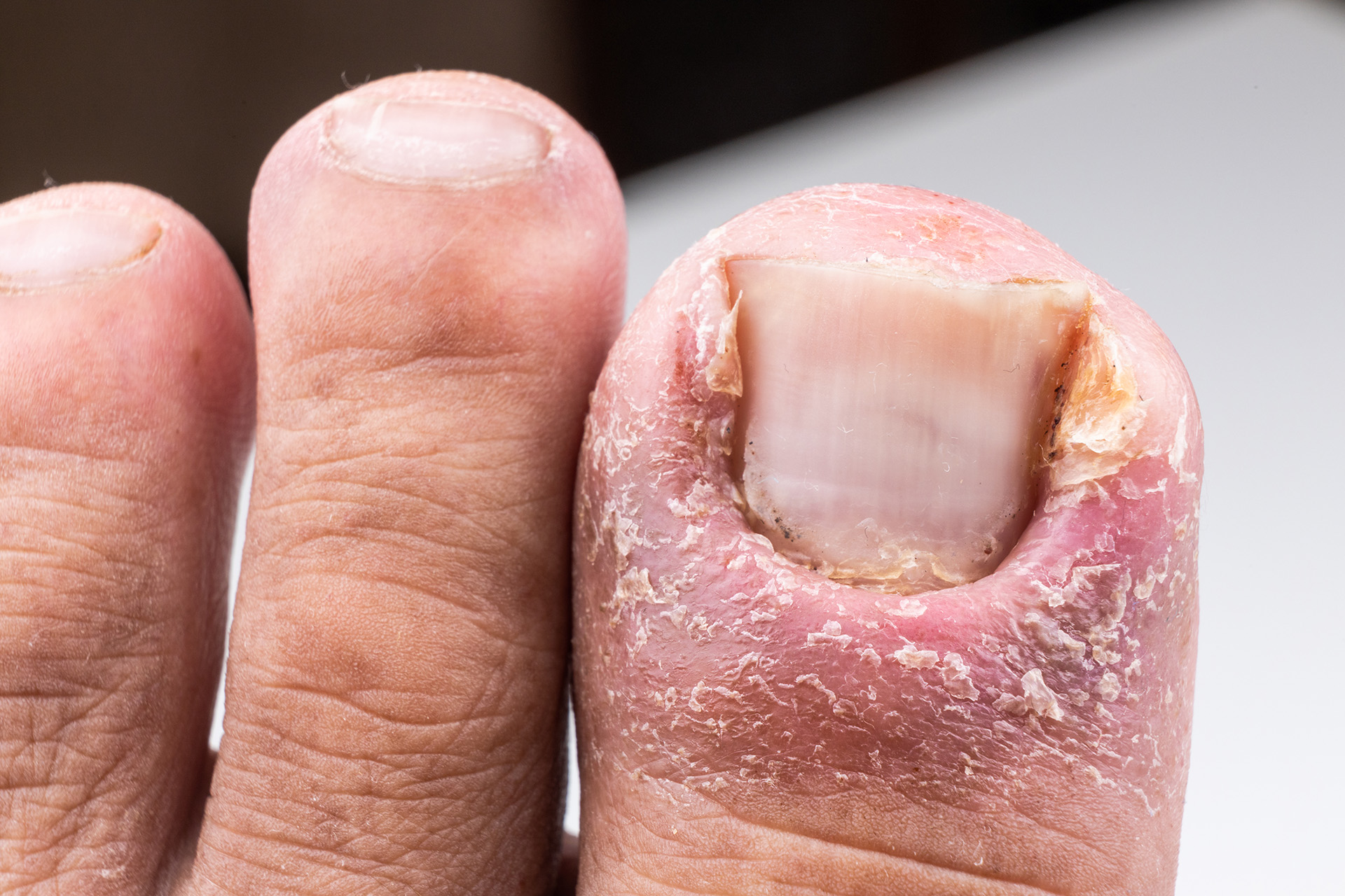 what-causes-fungus-under-toenail