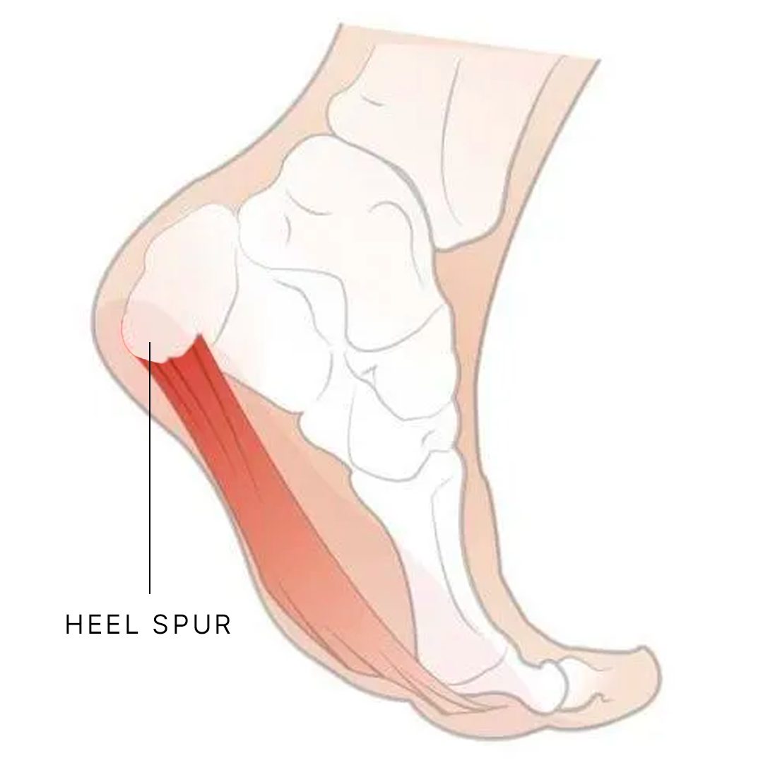 what causes heel spurs
