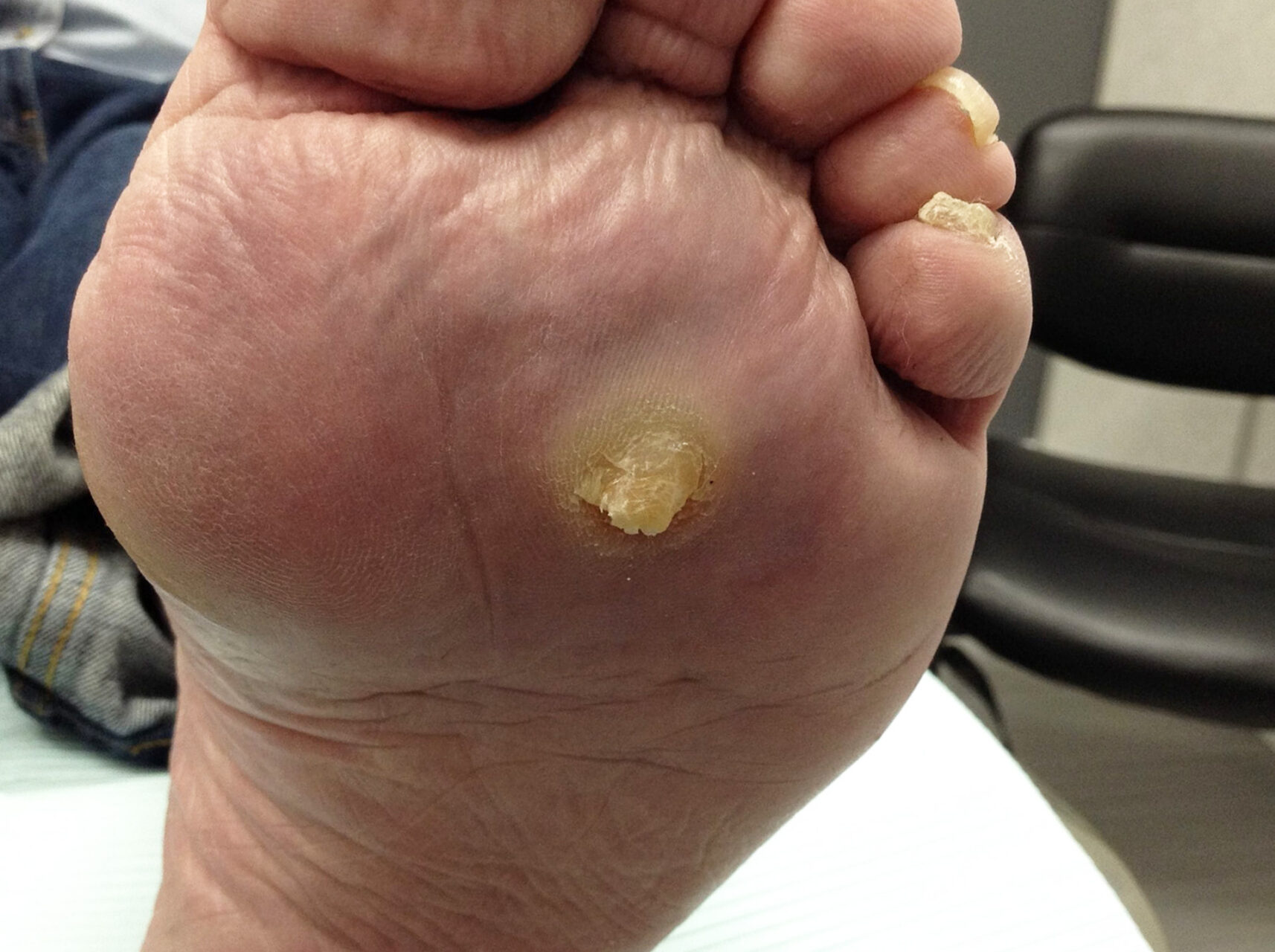 what is the difference between a corn and a callus