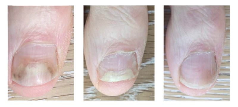 Fungal Nail Infections | Onychomycosis Treatment at The Foot Practice